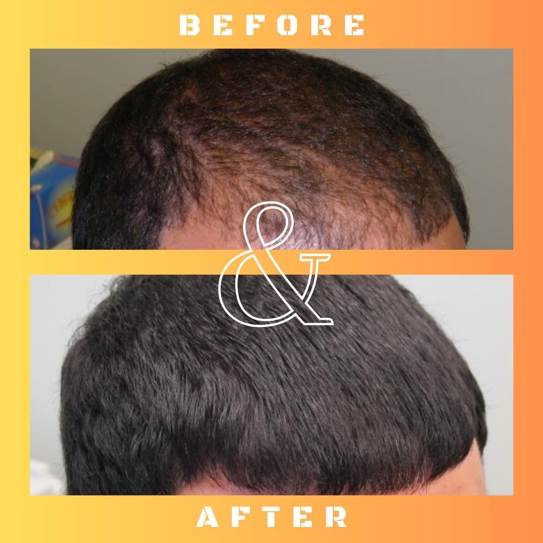 Mane Regain - RU58841 5% Solution (50 mg/ml) - DHT Blocker - Advanced Hair Loss Treatment - Anti-androgen Hair Tonic - Promotes hair regrowth and prevents hair loss