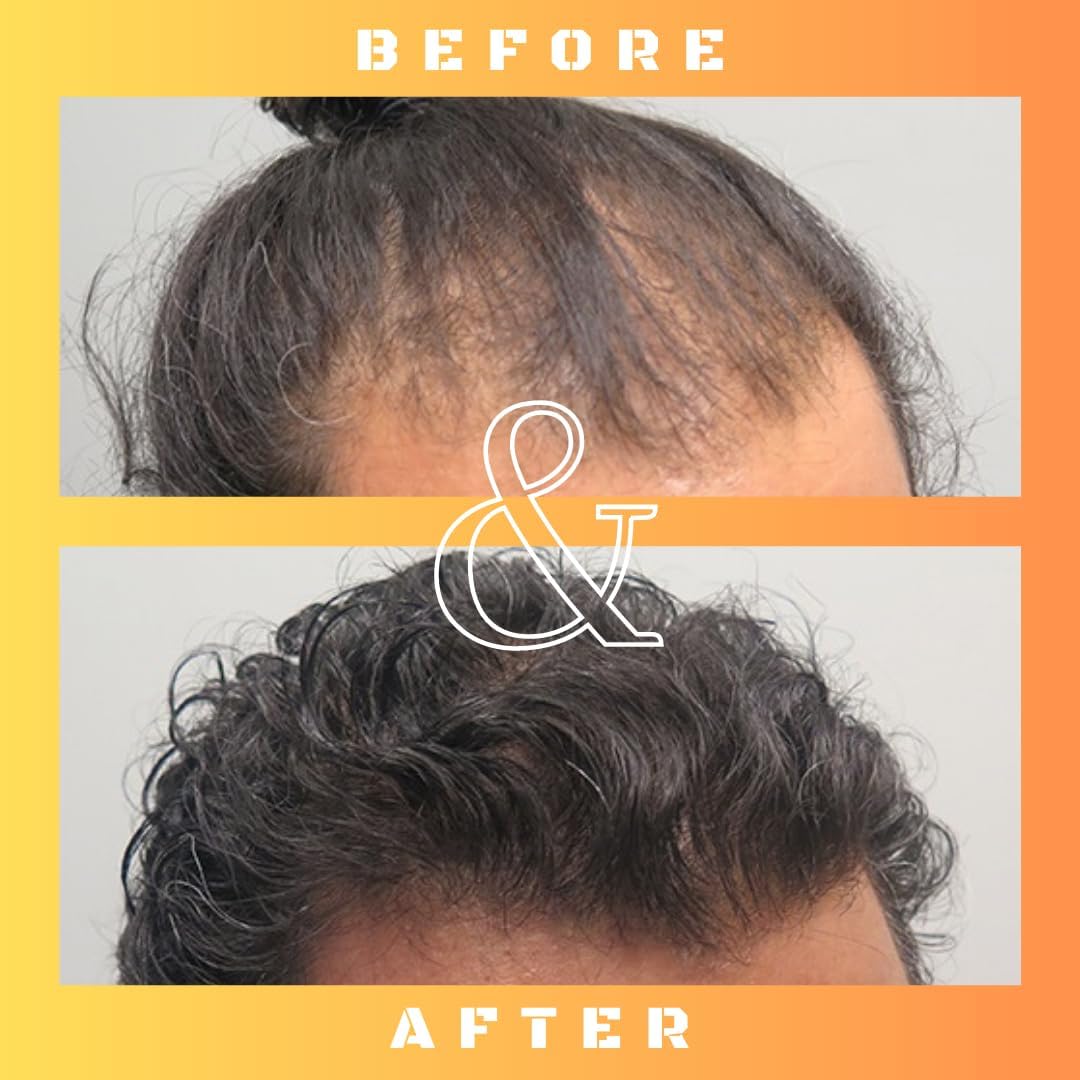 Mane Regain - RU58841 5% Solution (50 mg/ml) - DHT Blocker - Advanced Hair Loss Treatment - Anti-androgen Hair Tonic - Promotes hair regrowth and prevents hair loss