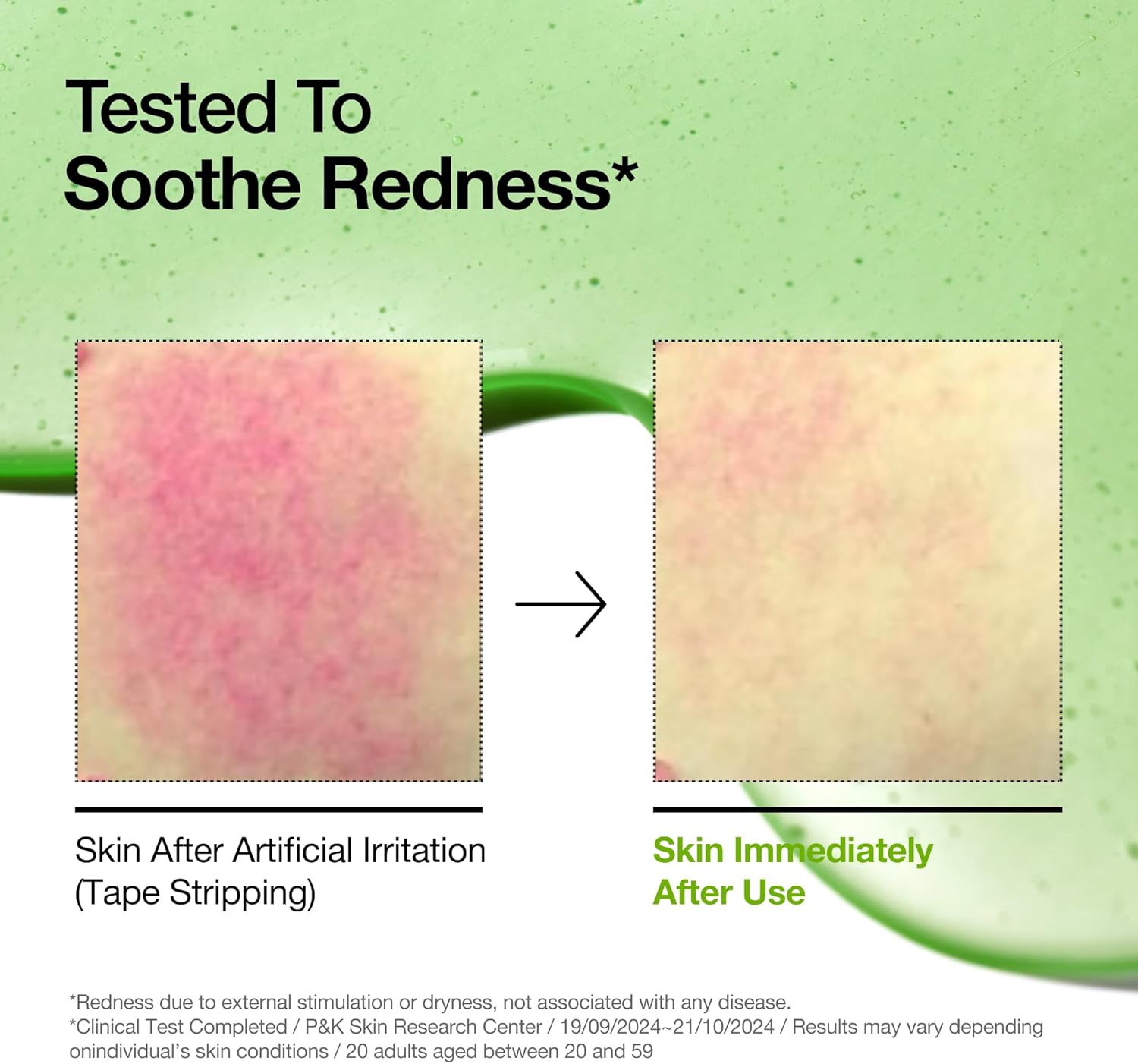 ANUA Soothing Anti-Redness Serum with Azelaic Acid 10 Hyaluronic Acid, Facial Serum for Sensitive Skin (30 Ml/1.01 Fl Oz)